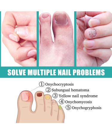 Fungal Nail Serum Pen with Tea Tree Oil and Aloe - Extra Strong Treatment for Toenails and Fingernails - Improve Damaged Nails - 1PCS - Buy Online on GoSupps.com