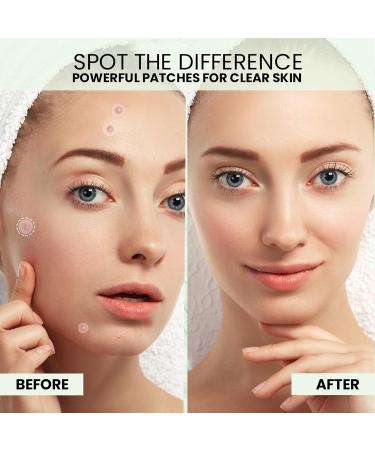 Buy Pimple Patches for Face - 108 Hydrocolloid & Hazel Acne Dots - Fast Acting Treatment (8mm & 12mm) - International Shipping Available - Buy Online on GoSupps.com