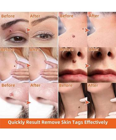 Skin Tag and Mole Removal Lotion - Fast-Acting Natural Remover for Warts - Easy Home Treatment (2PCS 40ML) - Buy Online on GoSupps.com