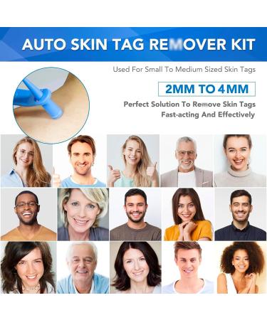 2-IN-1 Skin Tag Tool Kit for Men and Women Fast and Easy Painless Kit for Small (2mm) to Medium (8mm) - Safe for Most Parts - Blue (Blue) - Buy Online on GoSupps.com