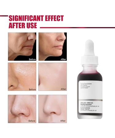AHA 30% + BHA 2% Peeling Solution AHA Exfoliating Facial Serum BHA Face Serum for Women Soothing Skincare Serum for Face Peeling Brightening Serum for Fighting Blemishes & Reduces Pore Congestion - Buy Online on GoSupps.com