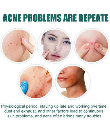 Anti Acne Face Cream Tea Tree Face Acne Gel Acne Scar Treatment Spot Cream for Acne Treatment and Spot Treatment Acne Cream Spot Treatment for Face Acne Scar Removal Cream Acne Moisturiser Face - Buy Online on GoSupps.com