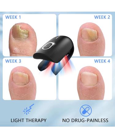 Nail Fungus Laser Treatment Device for Home Use | Effective Onychomycosis & Fungal Removal with 470nm Blue 660nm Red & 905nm Infrared Light - Buy Online on GoSupps.com