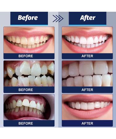 DIY Tooth Repair Kit: Moldable Thermal Fitting Beads for Temporary False Teeth - Restore Confidence in Your Smile - Buy Online on GoSupps.com