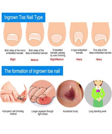 12pcs/Bo te Correcteur d'Ongles Incarn Lisseur des Ongles Traitement Incarn Traitement de l'Ongle Correction de l'Ongle Fiffeur de Fil Fiffeur d'Oiseau R cup rez les Soins de Pied - Buy Online on GoSupps.com