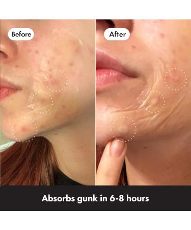 Hero Cosmetics Mighty Patch XL - 10 Large Hydrocolloid Surface Spot Patches | Day & Night Acne Treatment Stickers for Face & Body - Buy Online on GoSupps.com