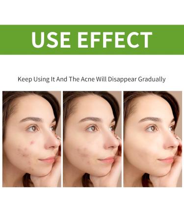 Jesswar Acne Treatment Face Cream - Cystic Acne Spot Treatment for All Skin Types (0.21 Oz) | Fast International Shipping - Buy Online on GoSupps.com