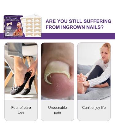 Ingrown Toenail Treatment Kit | Pain Relief Tool for Easy Trimming | Soften Nails & Straighten | Toenail Pain Relief Oil Drops | Natural 50 Patch Treatment - Buy Online on GoSupps.com
