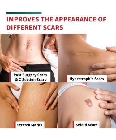 Medical-Grade Silicone Scar Tape Roll | Keloid & Surgical Scar Removal Strips | Reusable 4cm x 300cm | 2 Pack - Buy Online on GoSupps.com