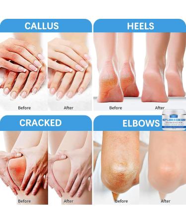 Urea Foot Cream 40% Urea Cream Cracked Heel Repair Cream with 2% Salicylic Acid Foot Cream for Cracked Heels and Dry Skin Moisturizing Callus Remover for Hand Foot Skin Care - Buy Online on GoSupps.com