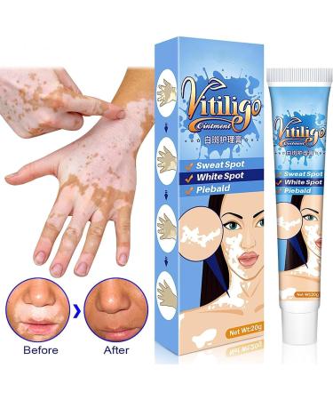 EXQST Vitiligo Therapy Cream - Reduce White Spots, Improve Skin Pigmentation - 5 Pcs - Buy Online on GoSupps.com