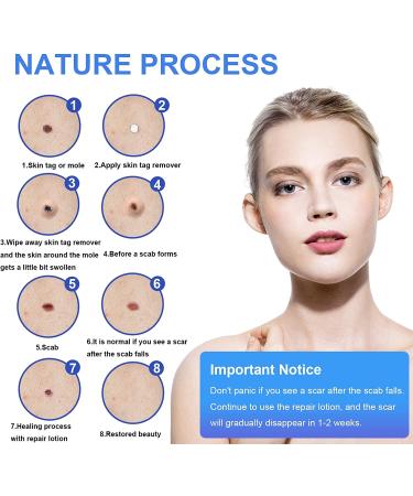 Skin Tag Remover - All Natural Mole and Skin Tag Removal Lotion - Scar-Free and Safe Solution - Buy Online on GoSupps.com