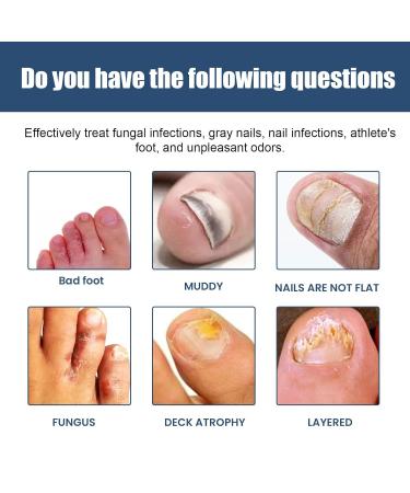 Furzero Medical Grade Nail Foot Spray - Foot Treatment Spray (1pc) - Buy Online on GoSupps.com