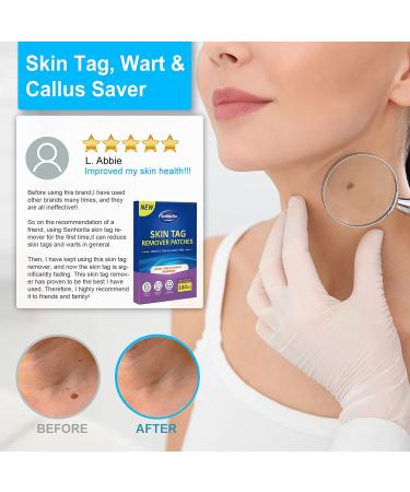 Skin Tag Remover Patches - 144Pcs | Safe & Painless Wart Removal for Face & Body - Buy Online on GoSupps.com