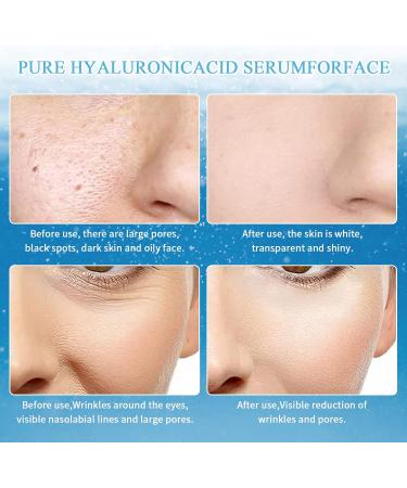 Daelesr 240 pieces of silk threads soluble protein threads for skin firming facial lifting contour lifting protein thread lifting set for lifting 20 packs - Buy Online on GoSupps.com