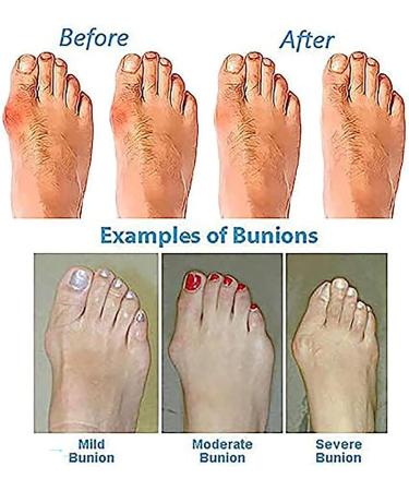 QLASIC Toe Correcting Orthopedic Sandals with Arch Support for Women - Purple, Size 7.5 - Buy Online on GoSupps.com