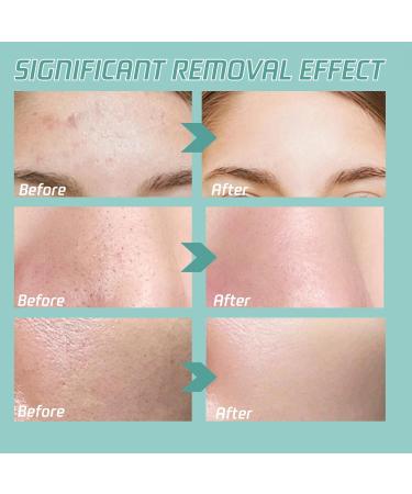 Acne Patches - Acne Treatment - Dark Spot Remover for Face - Liquid Pimple Patch - Spot Cream - 2% Salicylic Acid Acne Care - Face Saver Gel - Gentle Spot Gel Face Spot Treatment - Buy Online on GoSupps.com
