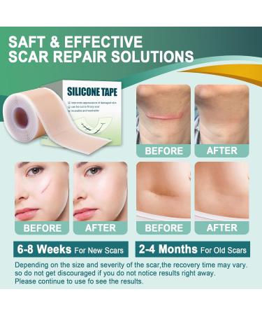 Surgical Scar Treatment Silicone Tape - Reusable Medical Grade Sheets for Keloid & Acne Scars (1.6 x 120 Roll) - Buy Online on GoSupps.com