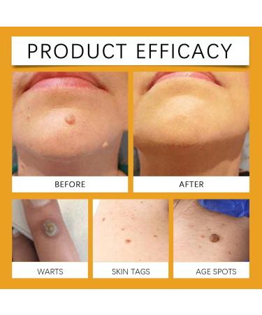 Bee Ve-nom Cream Bee Ve-nom Repair Cream Bee Ve-nom Moles and Warts Remover Cream Hydrating Moisturizing Treat-ment Cream Remove Spots for Women & Men for Back Neck Hands Feet Joints Etc. - Buy Online on GoSupps.com
