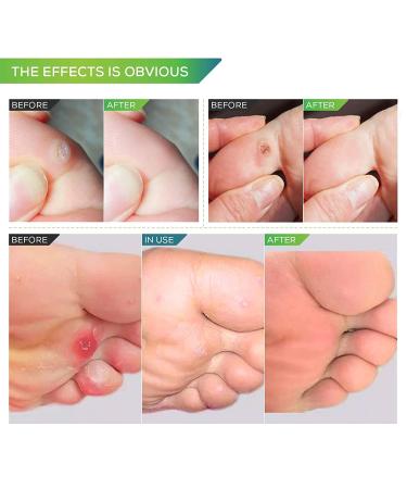 Samsali Corn Remover 42 Pack - Best Corn Remover for Feet and Toes, Callus and Corn Feet Remover - Toe Corn and Callus Removal Solution - Buy Online on GoSupps.com