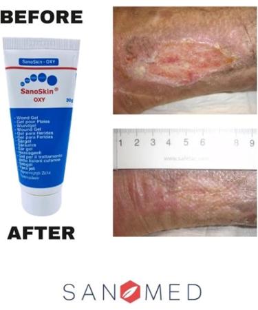 Sanoskin Oxy Wound Healing Gold 30G - Natural Treatment for Infected Wounds with Ozonized Olive Oil | Combat Bacteria Yeasts & Fungi - Buy Online on GoSupps.com
