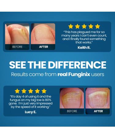 Funginix Healthy Nail Formula - USA-Made Treatment for Finger and Toe Fungus - Maximum Strength Solution (1oz) - Buy Online on GoSupps.com