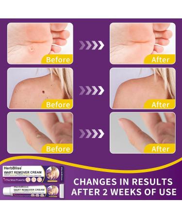 Wart Remover Cream 20g, Wart Removal Cream for Plantar Warts, Common Warts, Flat Warts - Buy Online on GoSupps.com