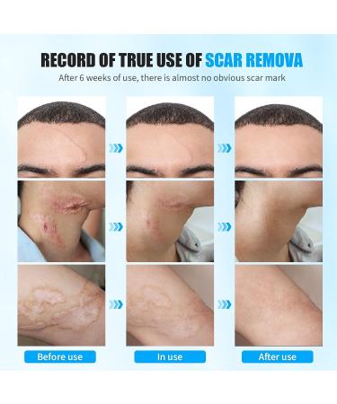 New Year Promotion: Scar Cream for Face and Body Repair - Reduces Surgery and C-Section Scars - 0.7 oz - Buy Online on GoSupps.com