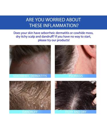 MENGCHEN Seborrheic Skin Cream Skin Problem Repair Skin Cream Repair Acne Head Itchy Scalp Ringworm - Buy Online on GoSupps.com