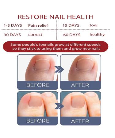 German Toenailplus & NailPro Anti Paronychia Relief Oil - Set of 2Pcs / 3Pcs - Buy Online on GoSupps.com