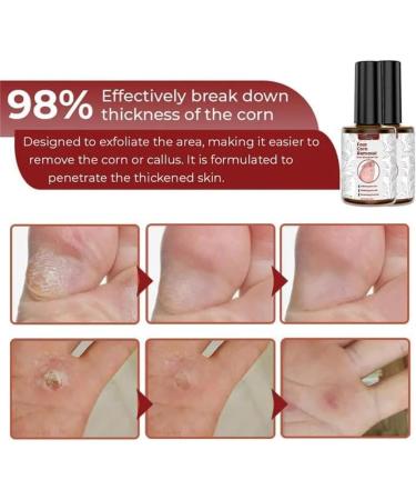 Extra Strong Foot Chicken Removal Gel - Effective Chicken Eye Remover for All Skin Types | Premium Foot Care Solution (1 Piece) - Buy Online on GoSupps.com