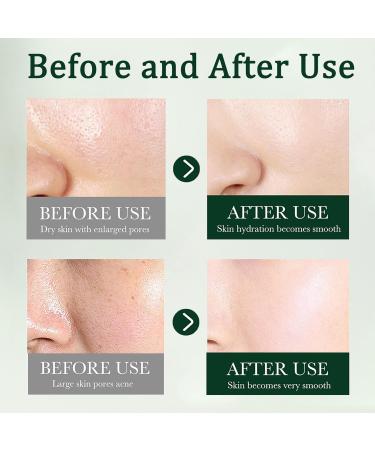 Tea Tree Acne Cream 50g - Spot Cream for Acne & Pimple - Dark Spot Remover for Face - Blackhead Remover Cream - Skin Care Face Cream for Women - Oil Control Soothing and Moisturizing Pimple Cream - Buy Online on GoSupps.com