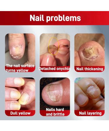 Nail Strengthening Treatment for Damaged Nails Nail Polish Strengthener Nail Hardner Oil Clear Nail Polish Strengthening Nail Growth and Strengthener Extreme Strength Nail Serum Nail Repair Serum - Buy Online on GoSupps.com