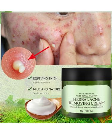 Acne Cream Moisturiser Face Cream Spot Cream Mens Moisturiser Tea Tree Cream Spot Cream For Acne Cream Moisturiser for Women Men Teenagers Dilute Face Prone Spot Marks Balance Facial Oil Cream - Buy Online on GoSupps.com