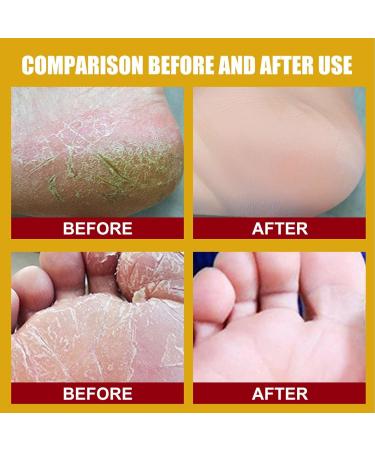 Yellow Banana Foot Cream - Natural Repair for Cracked Heels & Skin | 2PC 1g - Moisturize & Prevent Calluses - Buy Online on GoSupps.com