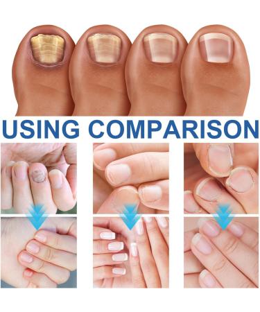 5pc 20mL Nail Women Man Nail Cuticle Puckery Nail Care Nutrition Moisturizing Nail Care Pens Cordless Drill Sanding Attachment (White One Size) 1 ml (Pack of 1) White - Buy Online on GoSupps.com