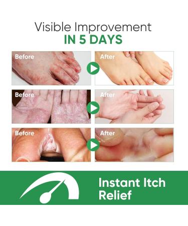 Extra Strength Athletes Foot Treatment Spray for Itchy, Inflamed, and Smelly Feet - 30ML (1FL.OZ) - Buy Online on GoSupps.com