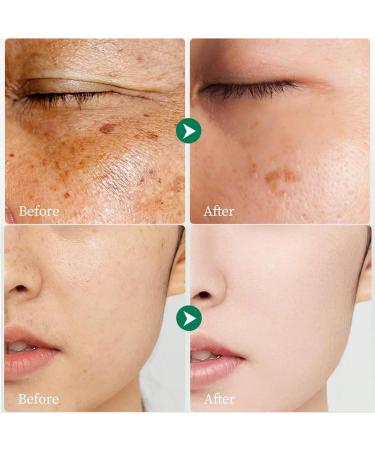 Crema para Manchas Oscuras en La Cara Crema para Las Manchas de La Cara Cremas para Quitar Manchas de La Cara 50 ML / 1.7 FLOZ - Buy Online on GoSupps.com