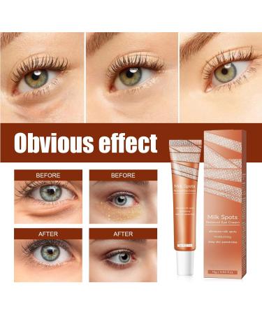 KOAHDE Milia Spot Remover Eye Creams Dark Circles Remover Lightens Cream Moisturizing Milia Eyes Cream Eye Creams Ruduce Milia Milia Removal Eye Creams Speedy Milia Remover Eye Cream 1PC - Buy Online on GoSupps.com