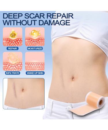 Buy Silicone Scar Sheets & Tape for Keloids C-Section Surgery & Acne - Reusable & Effective Treatment - Buy Online on GoSupps.com