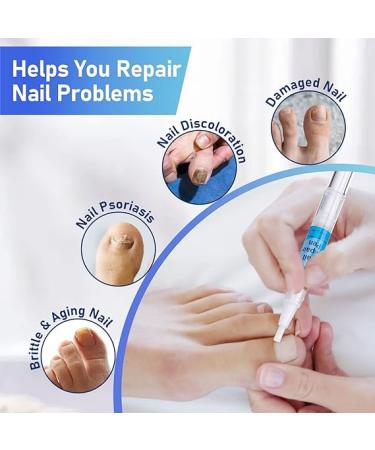 XIFEPFR Toenail Repair Pen - Nail Fingernail Repair Pen for Thick  Broken  Discolored Nails - Restores Healthy Strong Nails - 4PCS - Buy Online on GoSupps.com