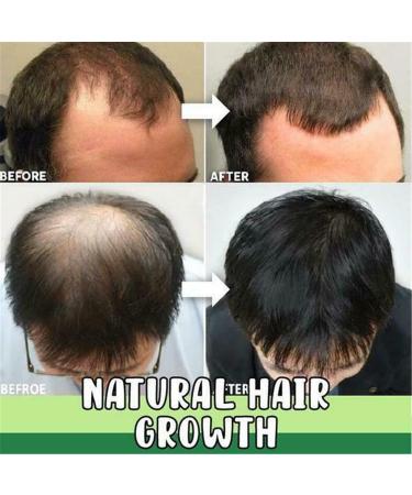 7 Day Herm Germinal Serum - Organic Hair Regrowth Kit | Accelerate Hair Growth & Prevent Hair Loss - Buy Online on GoSupps.com