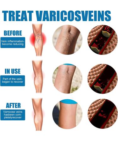 30ml Varicose Veins Treatment Spray | Massage Care Solution for Smooth Vein Bump | Activate Leg Meridians - Buy Online on GoSupps.com