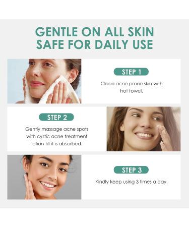 Cystic Acne Treatment: Effective Hormonal Acne Cream for Face | Acne Treatment - Buy Online on GoSupps.com