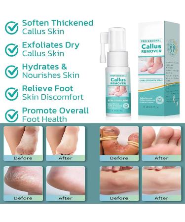 Professional Callus Remover Extra Strength Spray Foot Callus Removal Spray Foot Peeling Spray for Remove Dead Skin and Calluses on Feet (1Pcs) - Buy Online on GoSupps.com