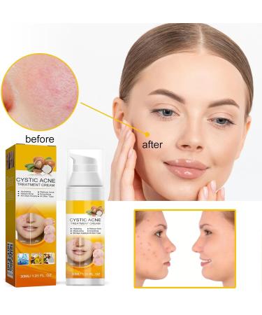 KOAHDE Facial Anti Acne Essence Acne Essence Anti Acne Hydrating Essence Anti Acne Facial Serum Acne Treatment Serum Serum Skin Smoother Acne Removing Moisturizing Serum Skin Rejuvenation Serum - Buy Online on GoSupps.com