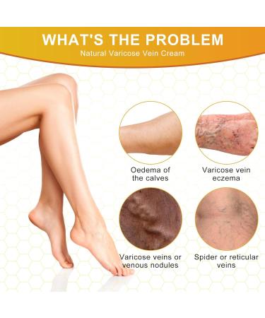 Bienengift Salbe - Beeergift Varicose Veins Cream for Spider Veins Relief | Pain & Swelling Relief (3 Pieces) - International Shipping Available - Buy Online on GoSupps.com