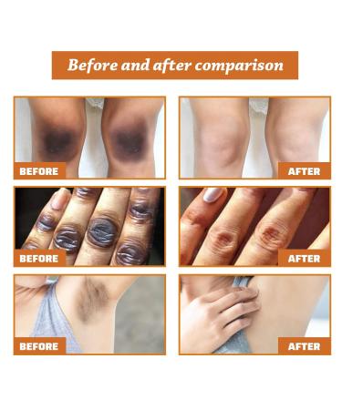 Fulvtuy JAYSUING Acanthosis Nigricans Therapy Oil - Reduces Dark Spots, Soothes Skin - 5 Pack - Buy Online on GoSupps.com