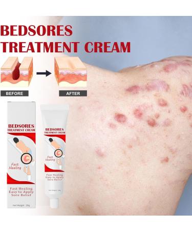  JPSDOWS Anti-Decubitus Cream | Anti-Decubitus Care 20g Healing Cream for Raping Pain Relief for Irritated Skin Difficult to Heal Skin - Relief Jpsdows - Buy Online on GoSupps.com