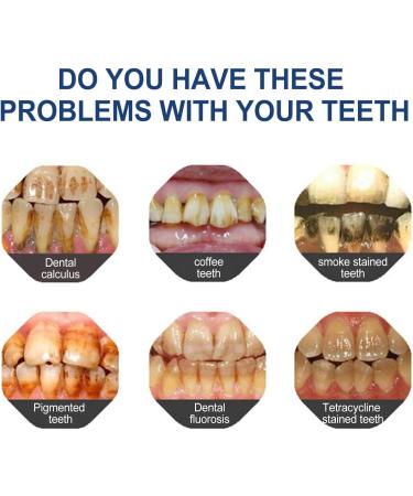 Teeth Whitening Abbey - Instant Brightening for Yellow & Discolored Teeth | Achieve a Radiant White Smile (1PC) - Buy Online on GoSupps.com